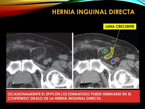 hernia inguinal directa e indirecta seram